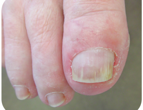 Hooldage ja ennetage tõhusalt küüneseent