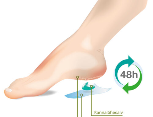 Hüperkeratoos – põhjused, sümptomid ja ravi